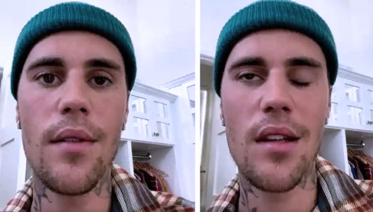 Muka Justin Bieber Lumpuh Separuh, Ini Penyebabnya