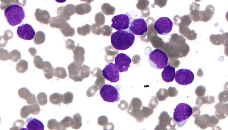 Tes Darah Sederhana Bisa Memprediksi Risiko Leukemia