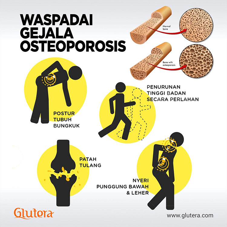 Glutera-gejala-Osteoporosis.jpg