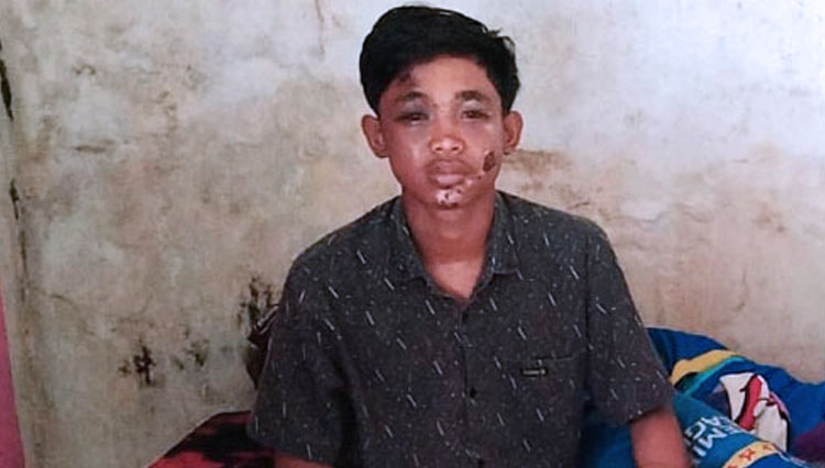 Nur Saguwanto with his wounded face and broken leg had to be treated at home for the hospital was full. (Photo: Binar Gumilang/TIMES Indonesia)