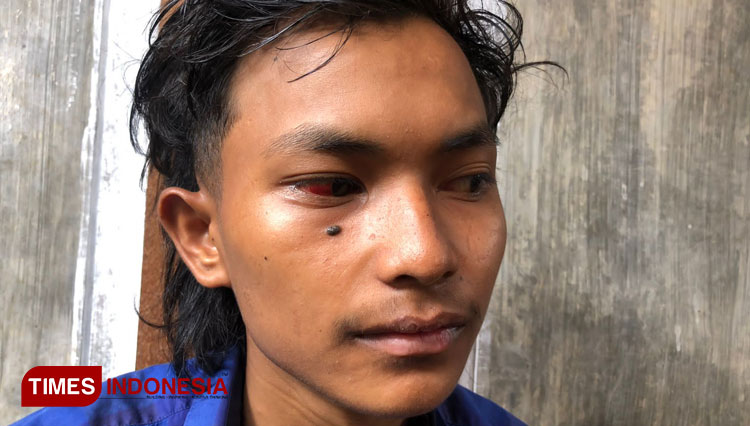 Iqbal and his red eyes after encountering three times tear gas shot during the soccer tragedy at Kanjuruhan Stadium. (Photo; Rizky Kurniaean Pratama/TIMES Indonesia) 