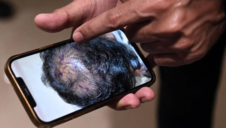 Asiya Begum ibu mendiang Athar Rasheed yang meninggal setelah transplantasi rambut. (FOTO: AFP/Getty Images)