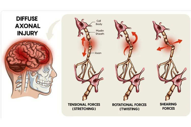 diffuse-axonal-injury-after-a-california-auto-accident