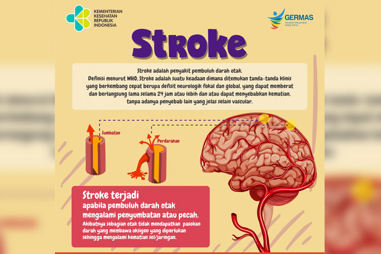 Ilustrasi penyakit stroke
