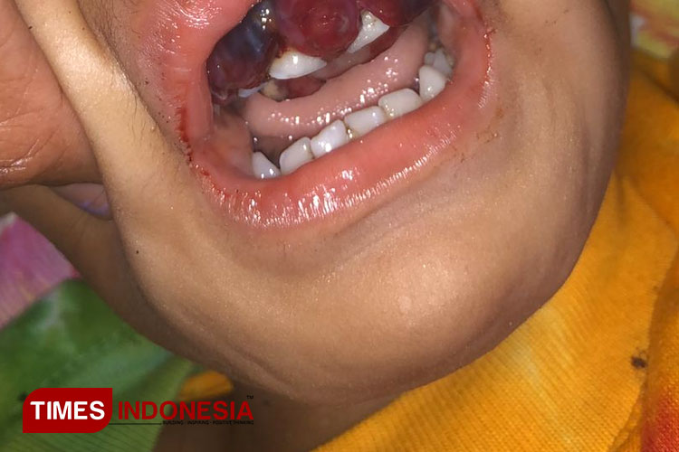 Kondisi M Atar Gibran saat menjalani pemeriksaan gusi yang divonis ada tumornya di RS Prima Ternate. (Foto: Husen Hamid/TIMES Indonesia)