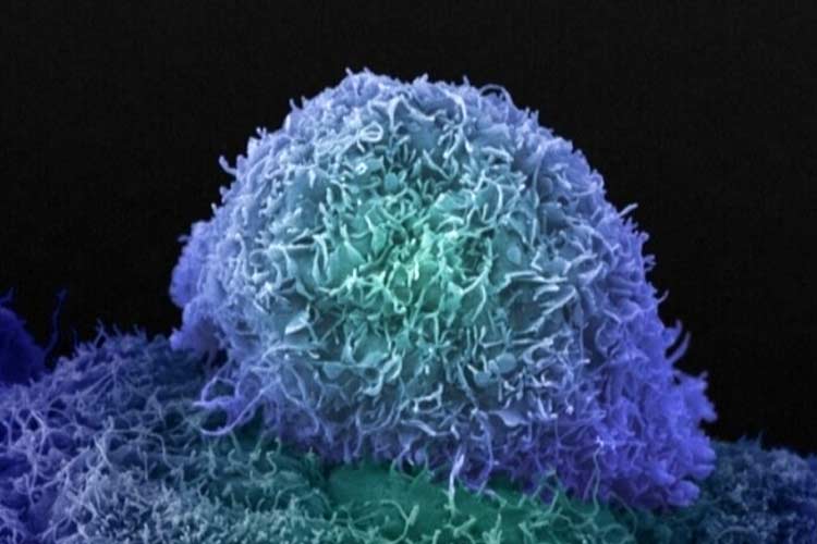 Gambar sel Kanker Prostat diambil menggunakan Scanning Electron Microscope. (FOTO: Cancer Research UK)