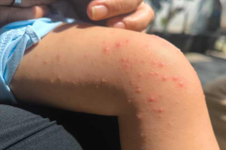 Kasus Flu Singapura Ramai Lagi di Indonesia, Kenali Gejala Hingga Pencegahannya