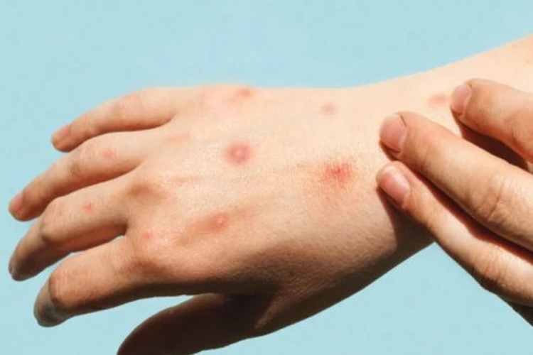 Ilustrasi gejala ringan penyakit Mpox (Monkey Pox). (Foto: Istimewa)