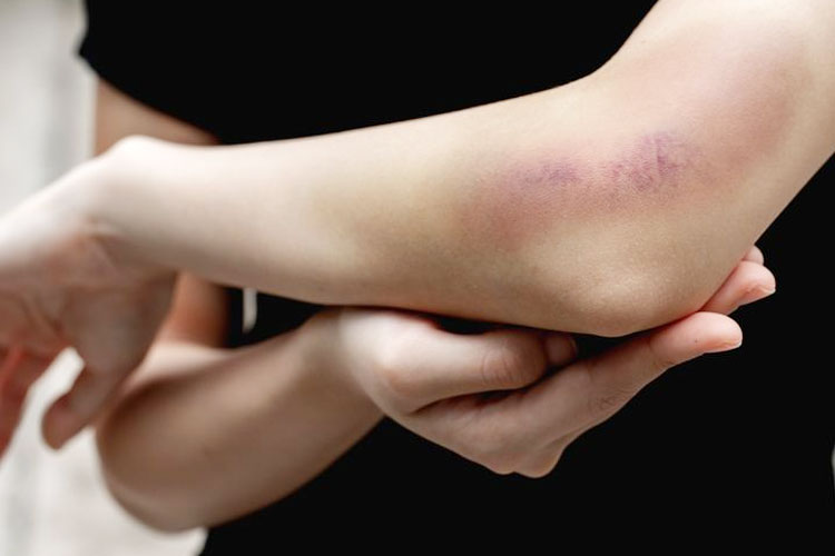 Punggu Satrio, bocah korban kekerasan ibu tiri di Banyuwangi, memar berbentuk telapak tangan. (FOTO; (shutterstock)