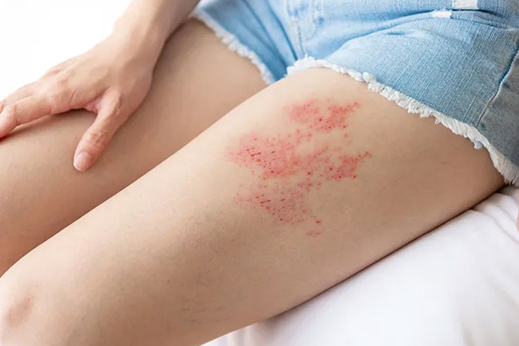 Kenali Ciri Penyakit Herpes Zoster dan Cara Pencegahannya