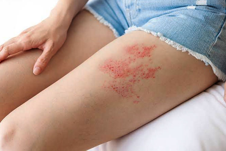 Kenapa Lansia Rentan Terkena Herpes Zoster? Ini Penjelasan Ketua Satgas Imunisasi Dewasa