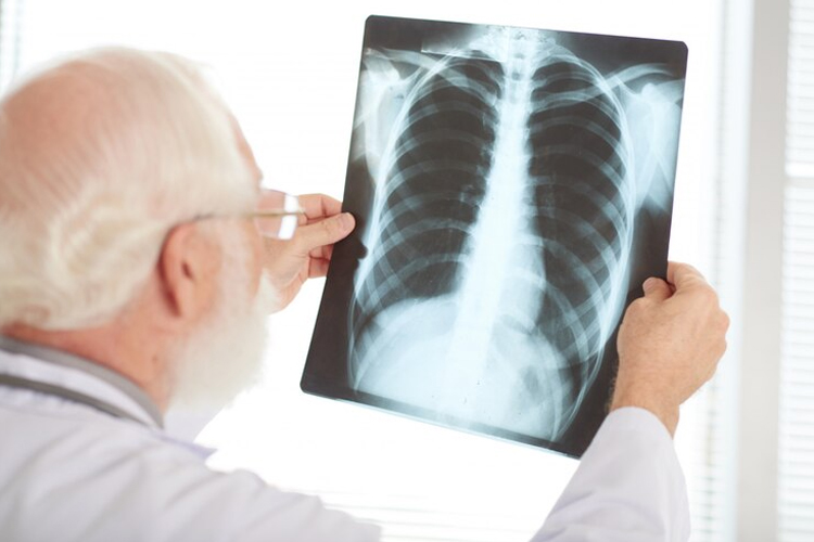 Ilustrasi. Infeksi pneumonia bisa semakin berat karena kurang istirahat. (Foto: Freepik)