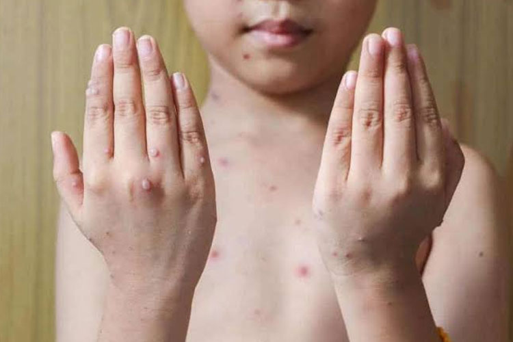 Secara umum, orang yang pernah terinfeksi cacar air akan memiliki kekebalan seumur hidup terhadap virus tersebut.