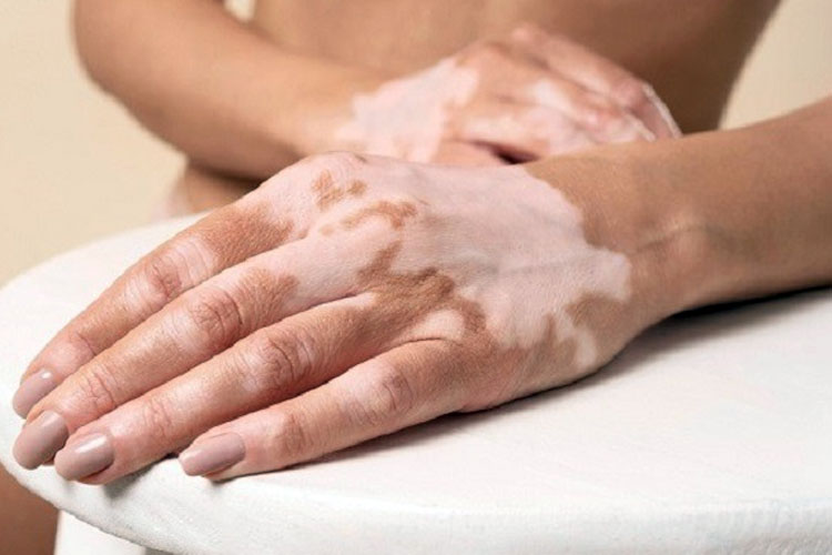 Ilustrasi Vitiligo. (Foto : Alodokter)