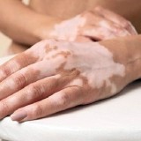 RSUD Genteng Banyuwangi Sediakan Alat Fototerapi UV untuk Penderita Vitiligo