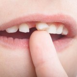 Gigi Goyang pada Orang Dewasa, Tanda Gangguan Serius Gusi dan Tulang