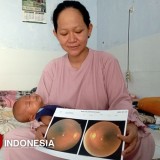 Idap Preeklampsia Ganggu Penglihatan, Ibu dengan Bayi di Malang Terkendala Pengobatan
