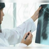 Pemerintah Tambah Anggaran Percepatan Deteksi TBC pada 2026